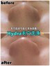 毛穴の黒ずみ&ザラつき徹底吸引♪思わず触りたくなる卵肌♪19800円→8800円!