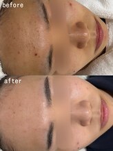 スパ ナナプラス(SPA nana+)/集中保湿◎光フェイシャル