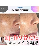エステティックサロン ラ アクア(ra aqua)/シミの種類に合わせた正しいケア
