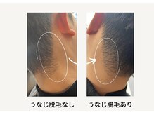 クレビア(CREVIA)/メンズうなじ脱毛◆BeforeAfter