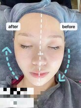 フイ(Hui)/試す価値あり！速効性小顔リフト