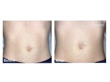 ロカビリー(Rockabilly)/メンズ　お腹脱毛