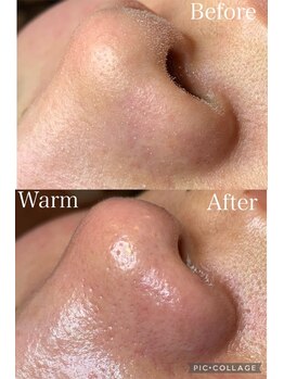 ウォーム(Warm)/20代女性毛穴エクストラクション