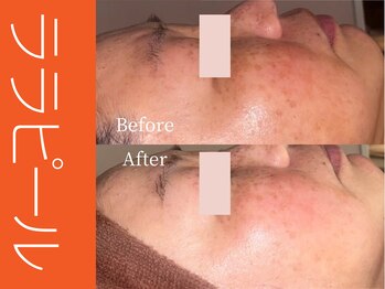 ビューティーリバース 湘南ちがさき店/ララピール50分