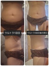 ヴィトワ(Vitowa)/ウルトランスフォーマー施術例1