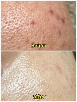 シャイン(shine)/光フェイシャル