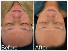 サロンドフェイス(Salon de Faith)/フォト+ハーブピーリング3回