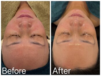 サロンドフェイス(Salon de Faith)/フォト+ハーブピーリング3回