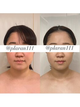 ボディヒーリングアンド小顔美容矯正 プララン/1回目→5回目ビフォーアフター