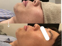 ヴィセラ(Vicella)/20代男性　ヒゲ全体
