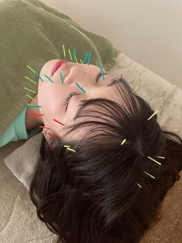 ハウオラ 恵比寿2(HAUOLA)の写真/【美容鍼】＋不眠や首肩こり、眼精疲労の慢性的なお悩みも改善！