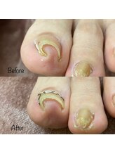 からだ工房/巻いてしまった爪を綺麗にケア