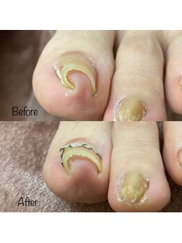 からだ工房/巻いてしまった爪を綺麗にケア