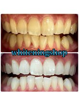 ホワイトニングショップ 立川店/【立川】美白ホワイトニング