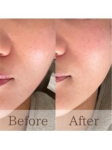 凪眠/小顔リンパフェイシャルの効果54