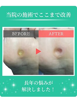 フルフィル 高田馬場店/たこ・魚の目・角質ケア