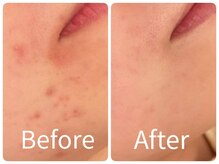 サロン ド ヒノキ(Salon de HINOKI)/肌質改善ハーブピーリング