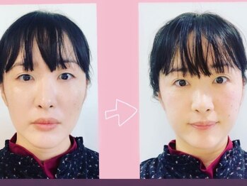 ゆうき式小顔矯正/小顔矯正before&after