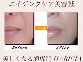 ハリシア(HARICIA)/ほうれい線の改善