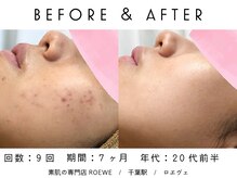 ロエヴェ(ROEWE)/ニキビ改善・毛穴ケア・肌質改善