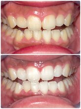 エクシアホワイトニング 札幌中島公園店/Before After［ホワイトニング］