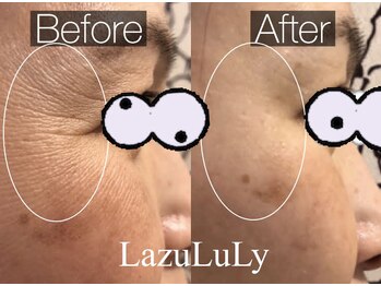 ラズリ(LazuLuLy)/乾燥/シワ/シミ/たるみ改善ケア