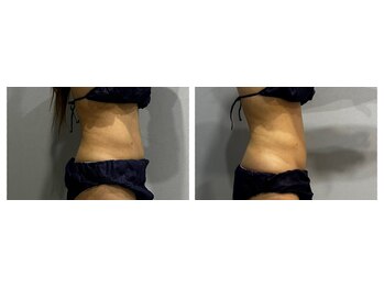 ラヴィエール(Laviere)/【レディース痩身120分】