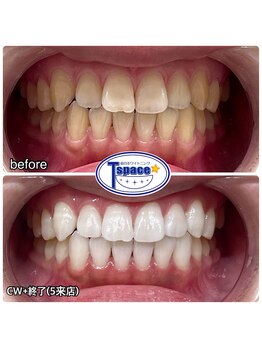 ティースペース 蒲郡店(T-space)/クリスタルWhite Plus