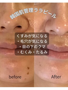 サロンドエンガワ(Salon de ENGAWA)/ララピールセラピールの効果