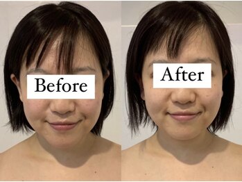 エレグラム(Elegram)/小顔矯正 施術