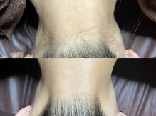 ゴールデンエイジ 吉祥寺(GOLDEN AGE)/ワックス脱毛：施術