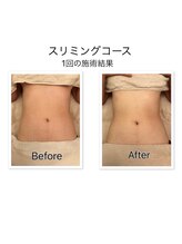 リラ(Rira)/痩身Before・After