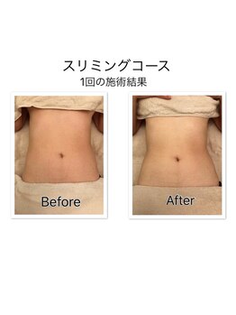 リラ(Rira)/痩身Before・After