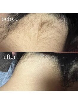 薫風/うなじ脱毛/20代