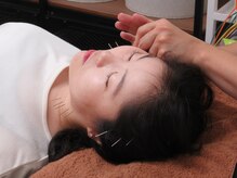 松尾美容鍼灸×整体 香椎/美容鍼施術風景です。