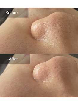 ハートランド(HEARTLAND)/夏場はより毛穴が目立つから