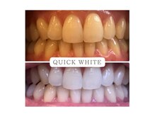 クイック ホワイト(QUICK WHITE)の雰囲気（見て！ホワイトニングでこんなに印象が変わるんです！絶対大事☆）