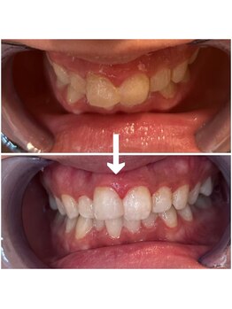 エクシアホワイトニング 代々木店/ビフォーアフター　代々木/新宿