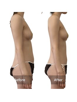 ベンザイ 梅田店(BENZAI)/反り腰、骨盤の歪み