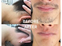 最新美肌脱毛とWAXの併用で効果実感◎即日ツルスベ