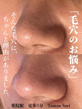 タマンサリ(Taman Sari)の写真/【夏の毛穴ケア】ララピールや毛穴な洗浄で小鼻の黒ずみを徹底的に◎フェイスライン・二重顎の小顔ケア付き