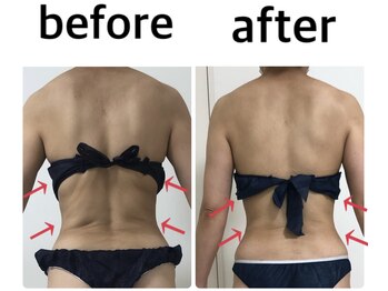 サロンドルフレ(salon de Reflet)/美背中トリートメント♪