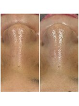 シエル(CieL)/気になるいちご鼻にも◎