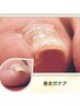 【お悩み解決】初めての　育成フット巻き爪ケア【7700円】