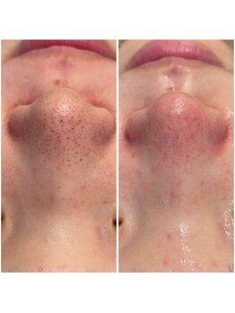 リッツ 草加店(Ritz)/【Before/After】毛穴