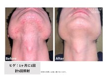 フィルムス(FILMS.)/ヒゲ脱毛のBeforeAfter