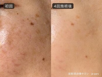 ジュパール(je pars)/シミ専用ハーブピーリング