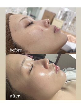 ラヴィリス(Raviliss)/ホワイトスノーピール