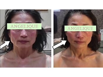 アンジェリーク/40代からの小顔矯正リフトアップ
