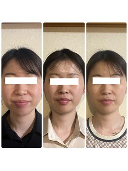 ジャスミン(Jasmine)/頭蓋骨小顔矯正